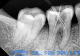 牙齿根管治疗两次还会疼痛怎么办(牙齿根管治疗期间疼痛怎么办)
