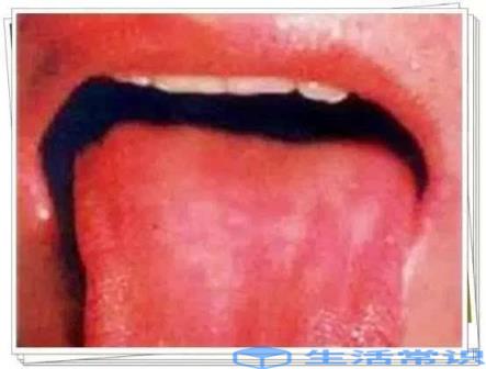 舌头上有红色凸起肉粒流血怎么办