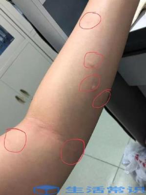 两岁孩子被蚊子咬出现红圈怎么办