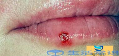 嘴巴疱疹结痂了可见水吗